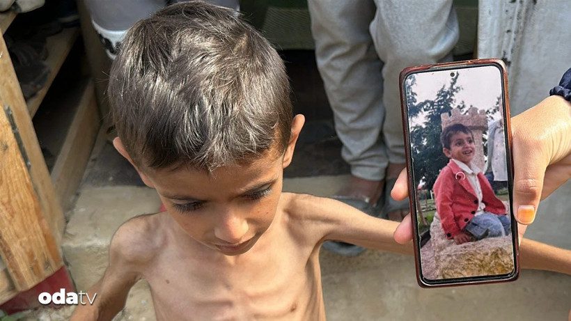 Gazze’de Çocuklar İçin Kronik Yetersiz Beslenme Krizi: Kaygıverici Boyutlar ve Sağlık Sistemine Yansıması