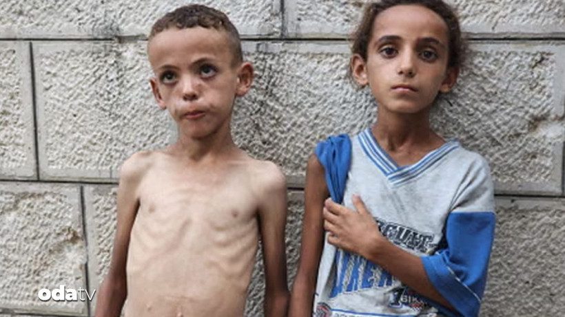 Gazze’de Çocuklar İçin Kronik Yetersiz Beslenme Krizi: Kaygıverici Boyutlar ve Sağlık Sistemine Yansıması
