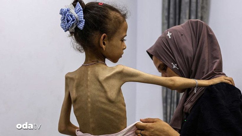 Gazze’de Çocuklar İçin Kronik Yetersiz Beslenme Krizi: Kaygıverici Boyutlar ve Sağlık Sistemine Yansıması