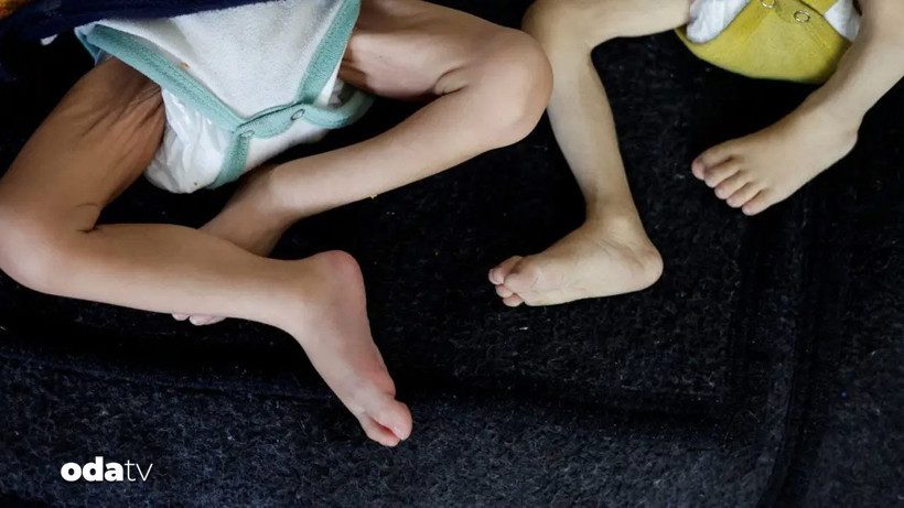 Gazze’de Çocuklar İçin Kronik Yetersiz Beslenme Krizi: Kaygıverici Boyutlar ve Sağlık Sistemine Yansıması
